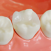 セラミックインレー（e-max)詰め物