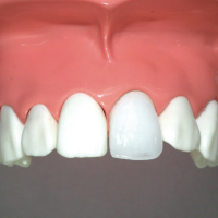 ジルコニアセラミック（前歯）