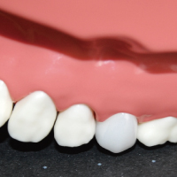 オールセラミック（e-max）